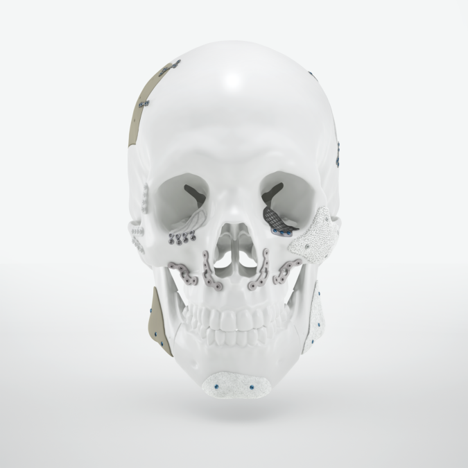 KLS Martin delivers their 500th Lithoz LCM-printed bioceramic implant via their surgeon-facing order platform IPS Gate®