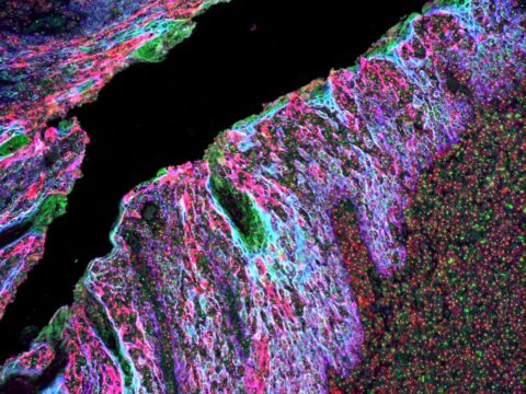 Ultra sensitive multiplex biomarker detection kits