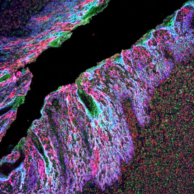 Ultra sensitive multiplex biomarker detection kits
