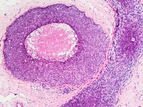 High RNA quality FFPE tissue blocks for biomarker discovery